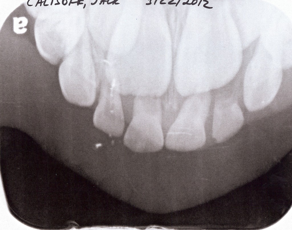 X-Ray of Jack's Teeth March 22, 2012